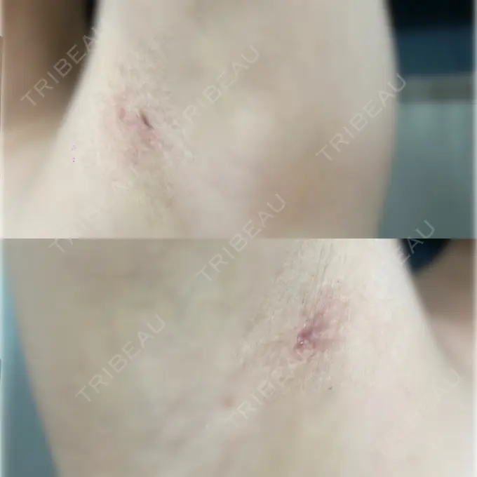 豊胸（脂肪注入） ルーチェクリニック 銀座院 DAY 56 メイン用