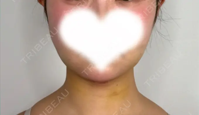 糸リフト / 脂肪吸引（顔） / ジョールファット除去 アリエル美容クリニック 水戸院 DAY 7 メイン用