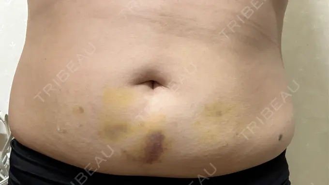 脂肪溶解注射（お腹） FIG CLINIC DAY 7 メイン用