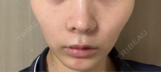 RF（高周波）たるみ治療 / インモード 豊洲内科・糖尿病 / 形成・美容外科クリニック DAY 4 メイン用