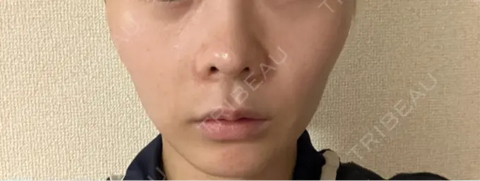 RF（高周波）たるみ治療 / インモード 豊洲内科・糖尿病 / 形成・美容外科クリニック DAY 7 メイン用