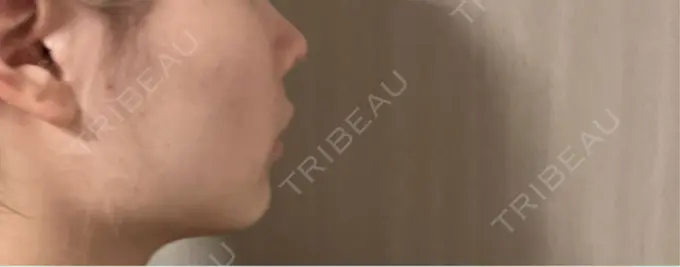 RF（高周波）たるみ治療 / インモード 豊洲内科・糖尿病 / 形成・美容外科クリニック DAY 10 メイン用