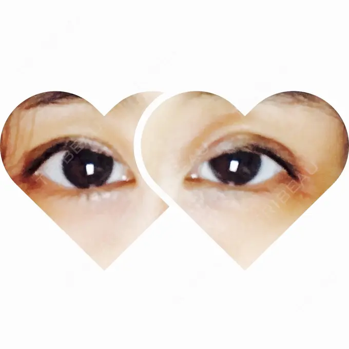 眼瞼下垂（切開） ブリスクリニック形成外科・美容外科・美容皮膚科 福岡 DAY 6 メイン用