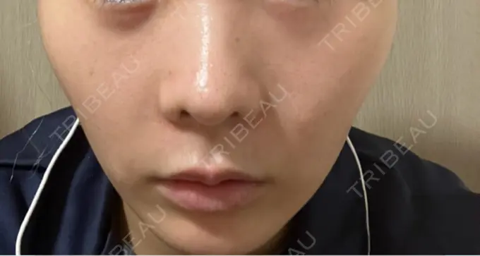 RF（高周波）たるみ治療 / インモード 豊洲内科・糖尿病 / 形成・美容外科クリニック DAY 9 メイン用