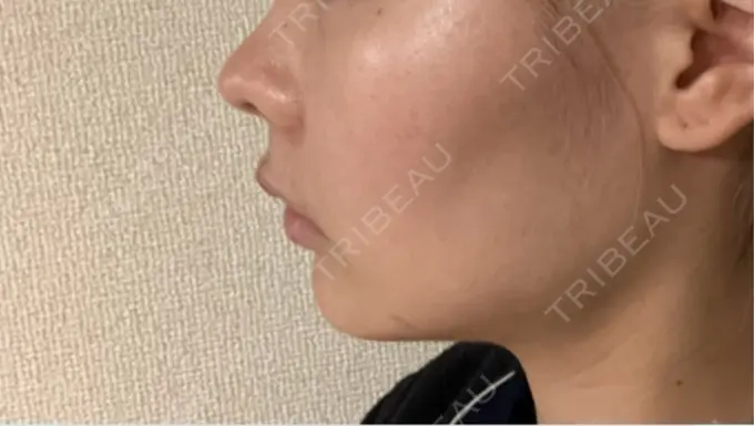 RF（高周波）たるみ治療 / インモード 豊洲内科・糖尿病 / 形成・美容外科クリニック DAY 12 メイン用