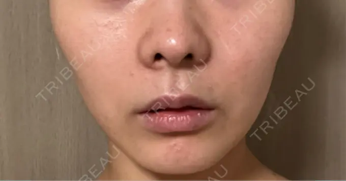 RF（高周波）たるみ治療 / インモード 豊洲内科・糖尿病 / 形成・美容外科クリニック DAY 13 メイン用