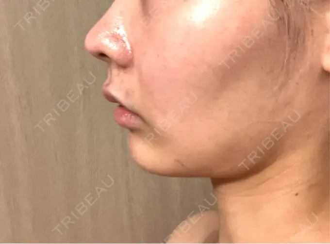 RF（高周波）たるみ治療 / インモード 豊洲内科・糖尿病 / 形成・美容外科クリニック DAY 14 メイン用