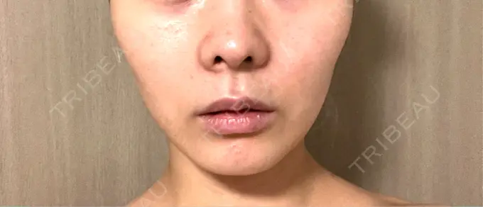 RF（高周波）たるみ治療 / インモード 豊洲内科・糖尿病 / 形成・美容外科クリニック AFTER メイン用