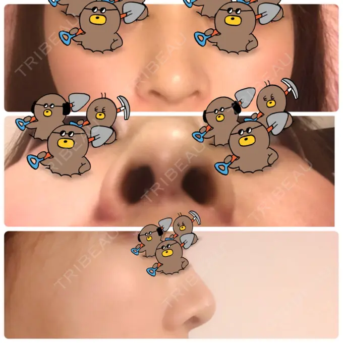 鼻尖形成（切開） / 軟骨移植 白山クリニック 大分 DAY 7 メイン用