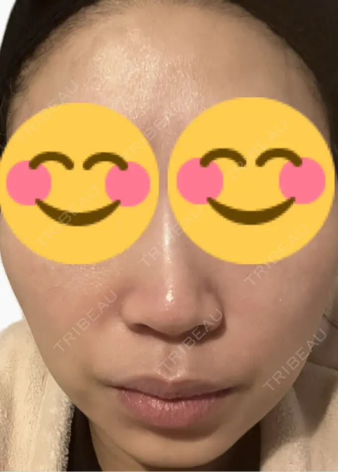 脂肪溶解注射（顔） 吉祥寺アイビークリニック DAY 3 メイン用