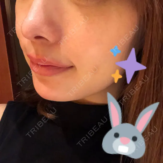 その他（輪郭） / その他（口元） / その他 ドクターゴールドマンクリニック 東京高輪院 DAY 7 メイン用