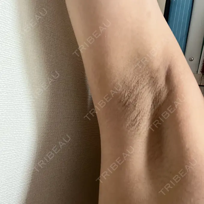 医療脱毛（ワキ） ルラ美容クリニック 渋谷本院 AFTER メイン用