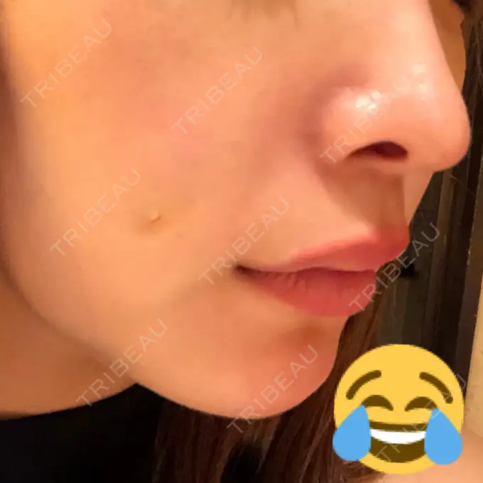 その他（輪郭） / その他（口元） / その他 ドクターゴールドマンクリニック 東京高輪院 DAY 7 メイン用