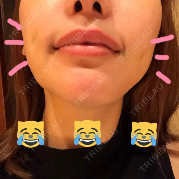 その他（輪郭） / その他（口元） / その他 ドクターゴールドマンクリニック 東京高輪院 DAY 7 メイン用