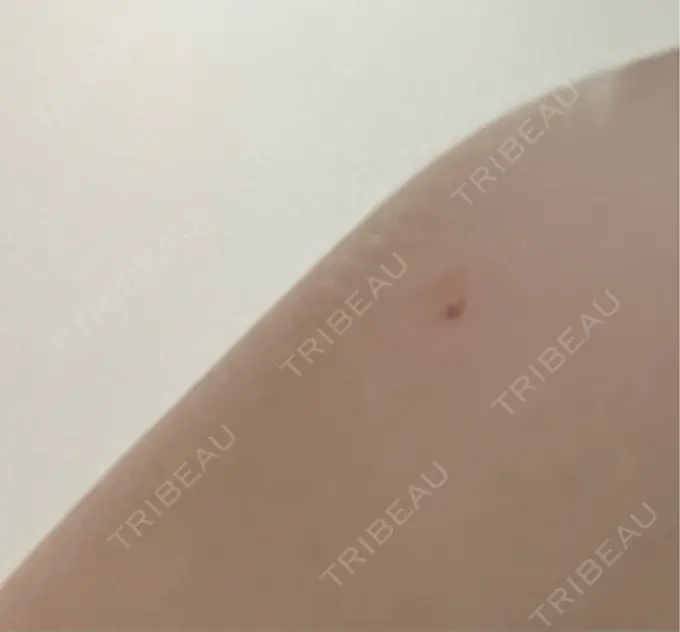 プラセンタ注射 美容皮膚科エルムクリニック 麻布院 AFTER メイン用