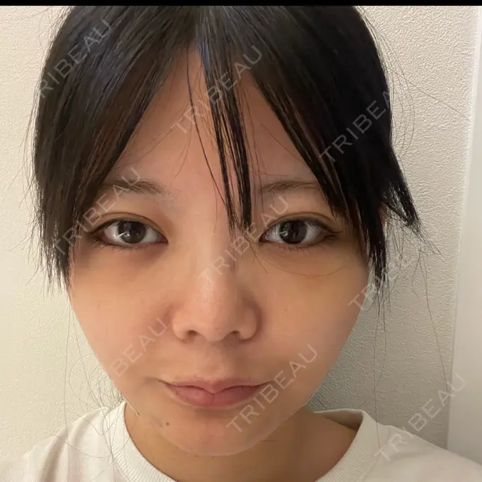 クマ治療 あじまビューティークリニック DAY 8 メイン用