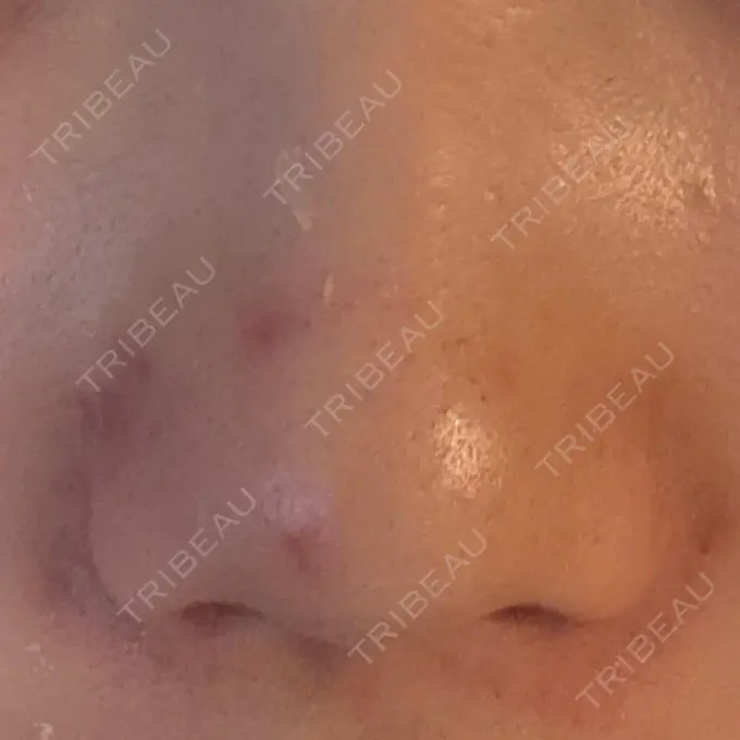 シワ取りボトックス ルラ美容クリニック 池袋院 AFTER メイン用