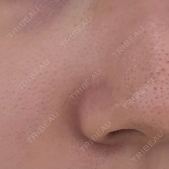 毛穴洗浄（ハイドラフェイシャルなど） / ルメッカ 東京シルククリニック 東京神田院 DAY 0 メイン用