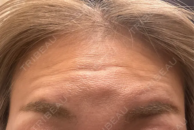 ボトックス（額） 小倉美容外科ネビュラクリニック DAY 4 メイン用