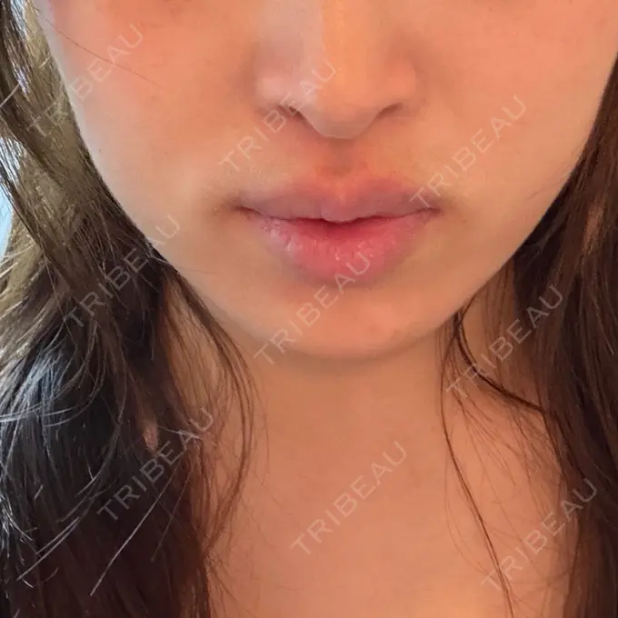 ボトックス（あご） / ボトックス（エラ・小顔） / ボトックス（口角） ルラ美容クリニック 神戸院 DAY 9 メイン用