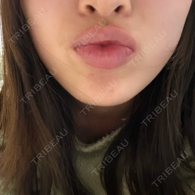 ボトックス（あご） / ボトックス（エラ・小顔） / ボトックス（口角） ルラ美容クリニック 神戸院 DAY 11 メイン用