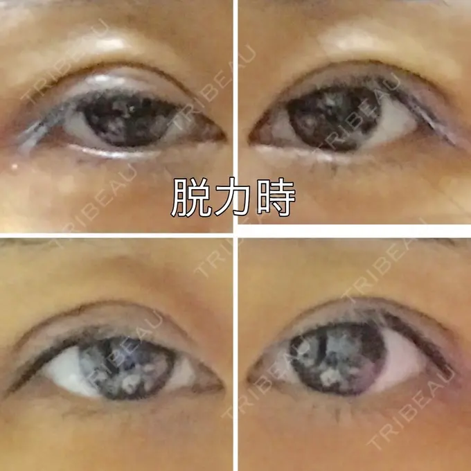 眼瞼下垂（切開） ブリスクリニック形成外科・美容外科・美容皮膚科 福岡 DAY 8 メイン用