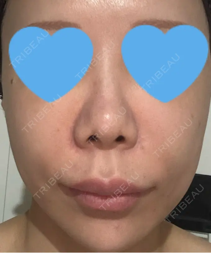 ボトックス（あご） / ボトックス（口角） / ボトックス（眉間） / ボトックス（目尻） / ボトックス（額） / ボトックス（人中） / その他（目元） eクリニック 岡山院 AFTER メイン用