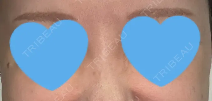 ボトックス（あご） / ボトックス（口角） / ボトックス（眉間） / ボトックス（目尻） / ボトックス（額） / ボトックス（人中） / その他（目元） eクリニック 岡山院 DAY 11 メイン用