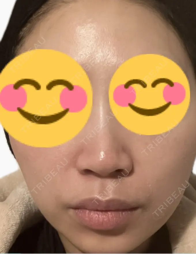 脂肪溶解注射（顔） 吉祥寺アイビークリニック DAY 4 メイン用