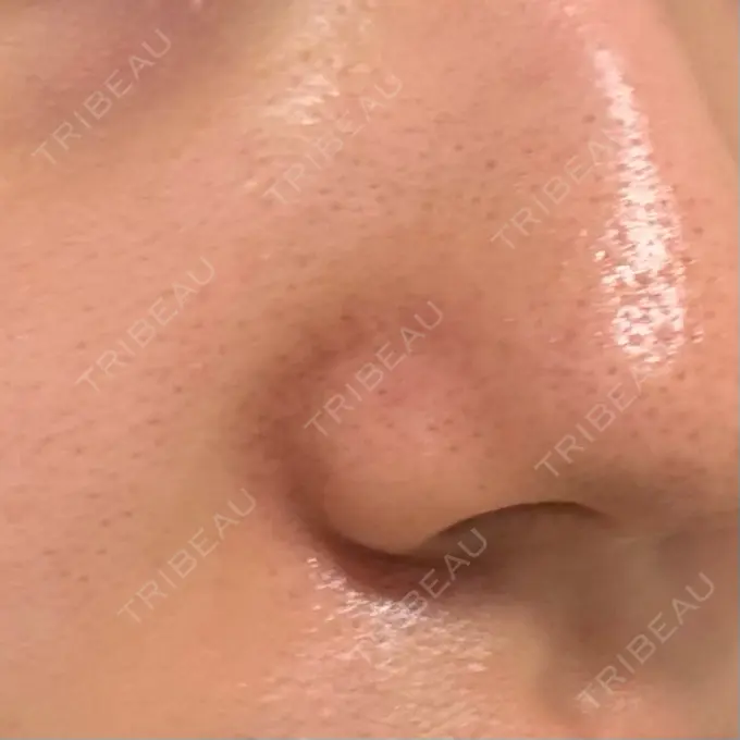 毛穴洗浄（ハイドラフェイシャルなど） / ルメッカ 東京シルククリニック 東京神田院 AFTER メイン用