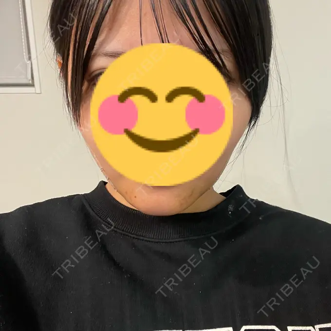 糸リフト / あご下筋肉縛り WOM CLINIC GINZA （ワム クリニック ギンザ） DAY 3 メイン用