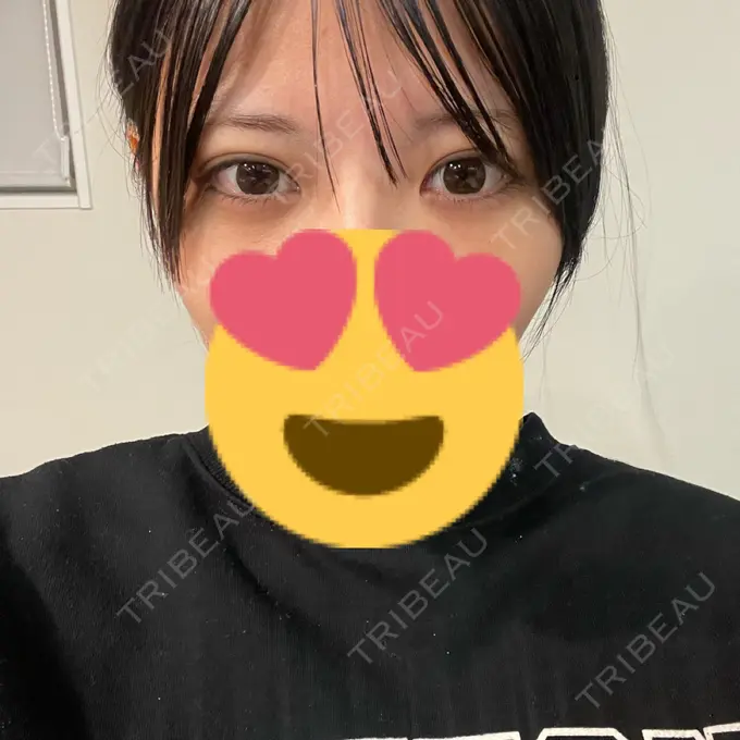 クマ治療 あじまビューティークリニック DAY 9 メイン用