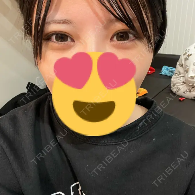 クマ治療 あじまビューティークリニック DAY 9 メイン用