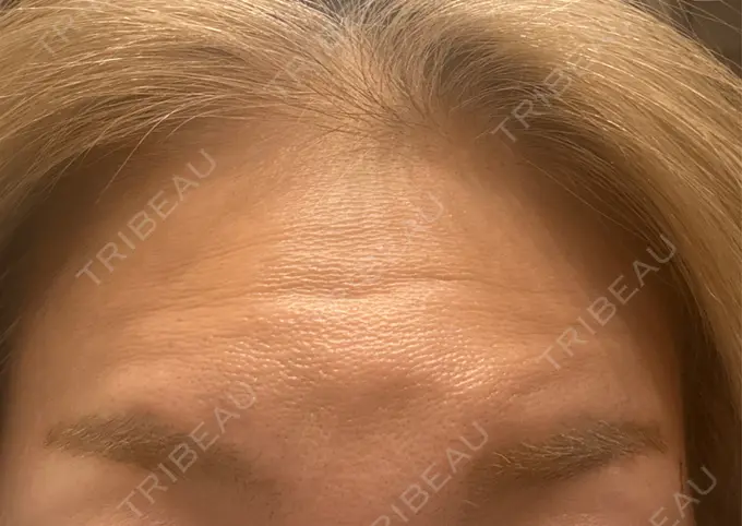 ボトックス（額） 小倉美容外科ネビュラクリニック DAY 5 メイン用