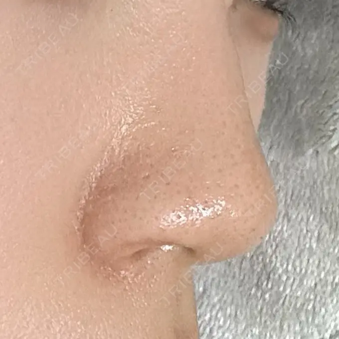 鼻孔縁挙上 シエルクリニック DAY 53 メイン用