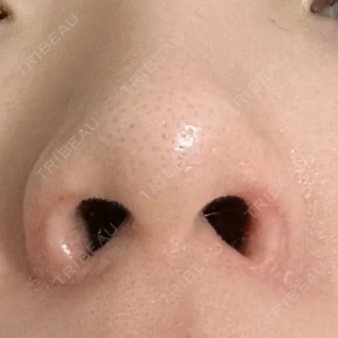 鼻孔縁挙上 シエルクリニック DAY 53 メイン用