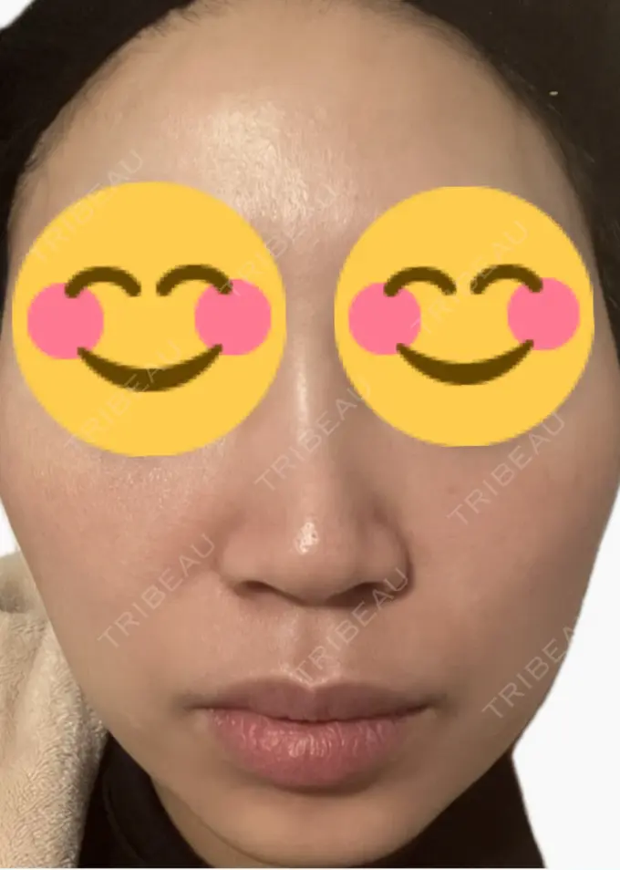 脂肪溶解注射（顔） 吉祥寺アイビークリニック DAY 5 メイン用