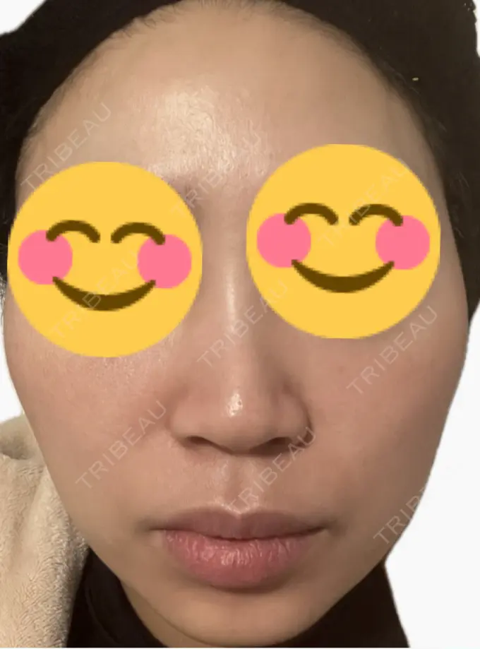 ルメッカ 東京シルククリニック 新宿院 DAY 1 メイン用