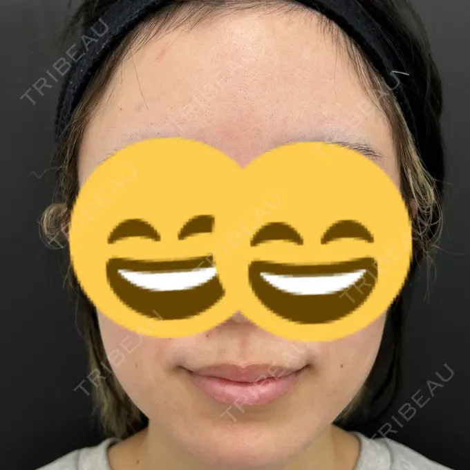 ボトックス（エラ・小顔） / ボトックス（口角） / ボトックス（眉間） / ボトックス（人中） つだ美容外科クリニック AFTER メイン用