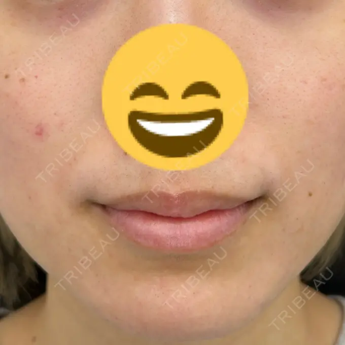 ボトックス（エラ・小顔） / ボトックス（口角） / ボトックス（眉間） / ボトックス（人中） つだ美容外科クリニック DAY 37 メイン用