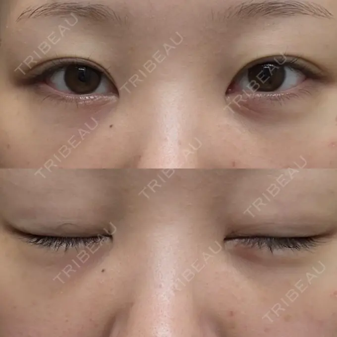 クマ治療 / 脂肪注入（目の下） 湘南美容クリニック 千葉センシティ院 DAY 14 メイン用