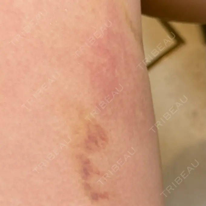 クマ治療 / 脂肪注入（目の下） 湘南美容クリニック 千葉センシティ院 DAY 14 メイン用