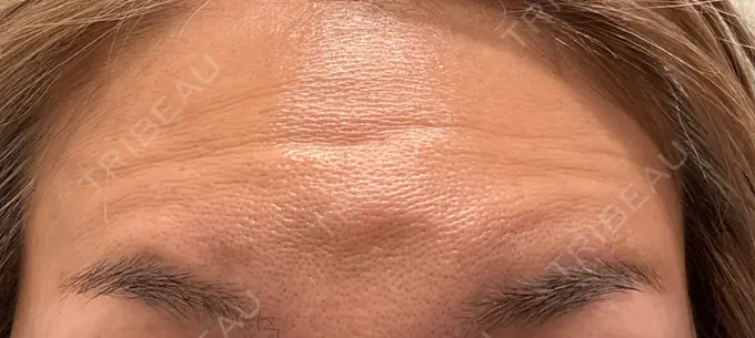 ボトックス（額） 小倉美容外科ネビュラクリニック DAY 6 メイン用