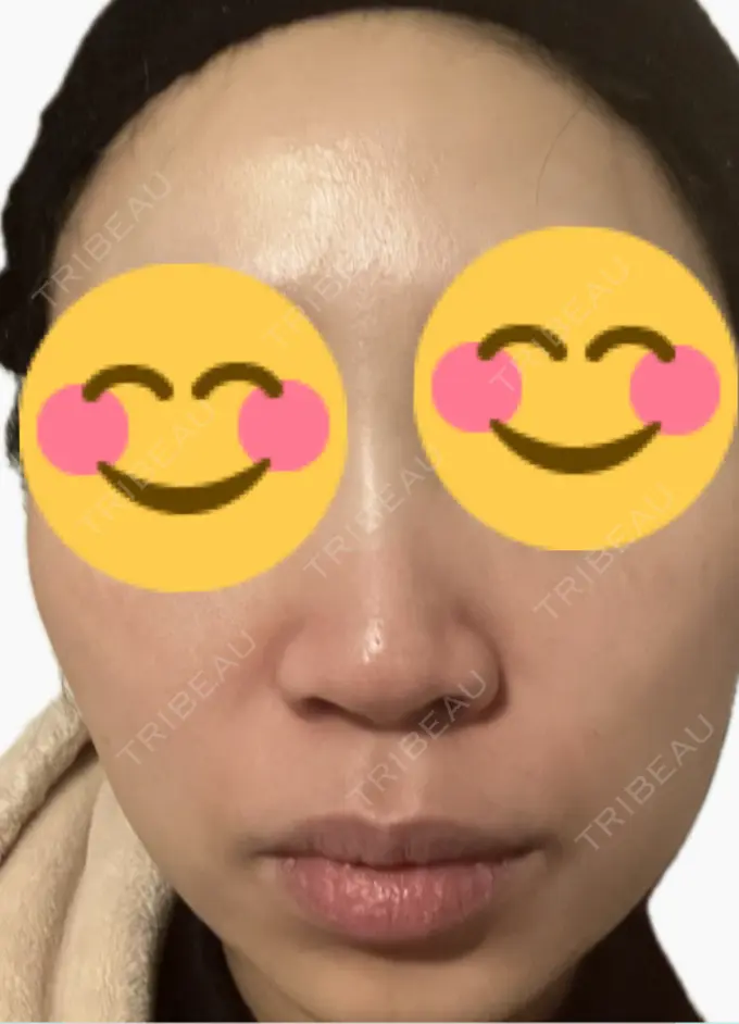 脂肪溶解注射（顔） 吉祥寺アイビークリニック DAY 6 メイン用