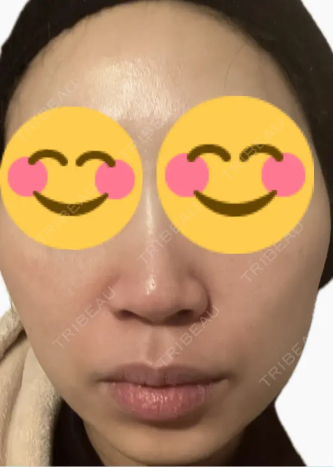 ルメッカ 東京シルククリニック 新宿院 DAY 2 メイン用