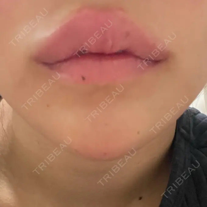 ボトックス（あご） / ボトックス（口角） / ボトックス（眉間） / ボトックス（首） / ボトックス（ガミースマイル） STELLA LUNNA CLINIC AFTER メイン用