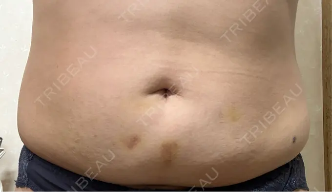 脂肪溶解注射（お腹） FIG CLINIC DAY 12 メイン用