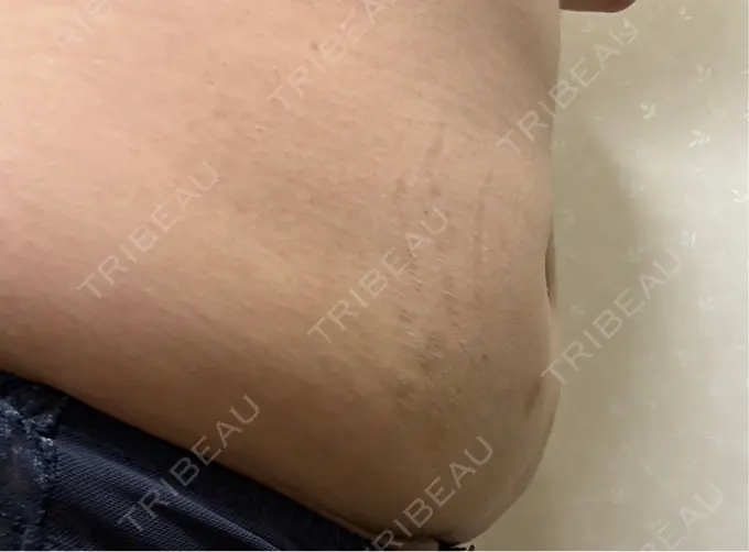 脂肪溶解注射（お腹） FIG CLINIC DAY 12 メイン用