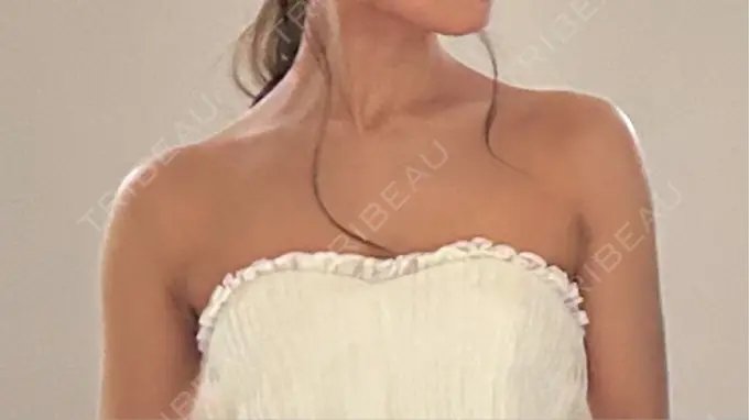 ボトックス（エラ・小顔） / ボトックス（肩） / ヒアルロン酸注入（鼻翼基部） 日比谷セントラルクリニック AFTER メイン用