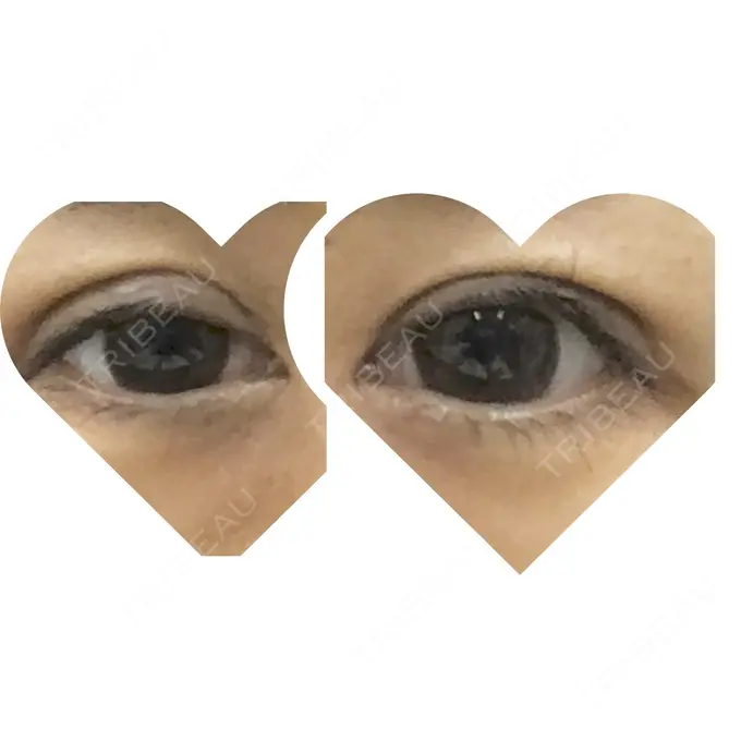 眼瞼下垂（切開） ブリスクリニック形成外科・美容外科・美容皮膚科 福岡 DAY 21 メイン用